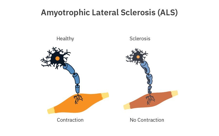 Amyotrophic Lateral Sclerosis Als Axion Biosystems